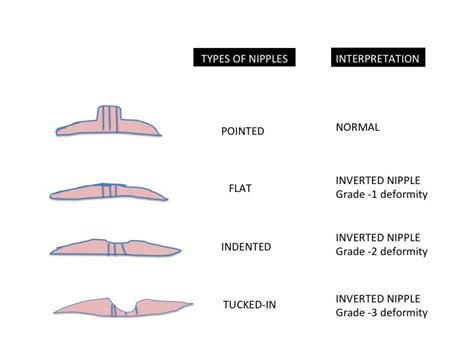 newly inverted nipple|Inverted Nipples: Common Causes